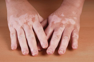 Illustration for article titled Penyakit Vitiligo